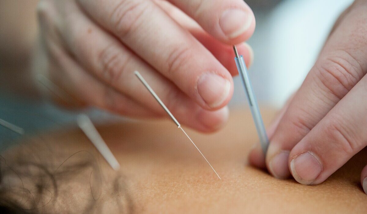 does-medicare-cover-acupuncture