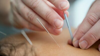 does-medicare-cover-acupuncture